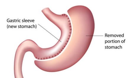 Benefits of Gastric Sleeve Surgery