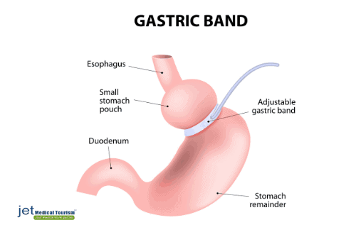 Gastric band surgery in Tijuana