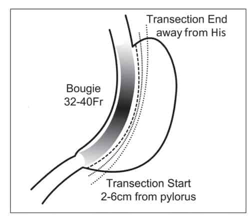 Gastric Sleeve Bougie Size
