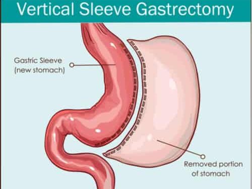 How Does Gastric Sleeve Work