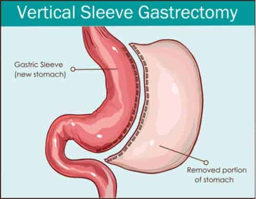 Gastric Sleeve Cures PCOS