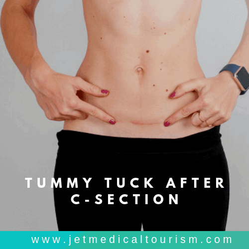Tummy Tuck after C Section