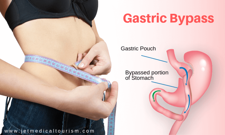 Gastric Bypass Surgery Cost in Mexico