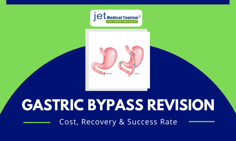 Gastric bypass revision cost