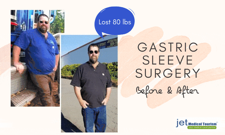 Before and After Photos of Gastric Sleeve Surgery