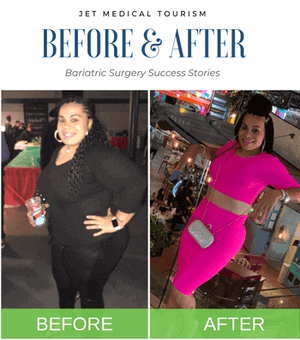 Gastric Sleeve Before After