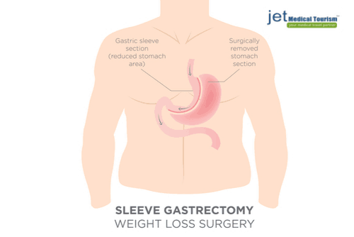 Gastric Sleeve Cost in Mexico