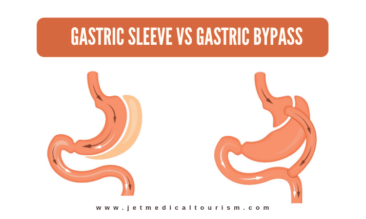 Which surgery is better: gastric sleeve or bypass