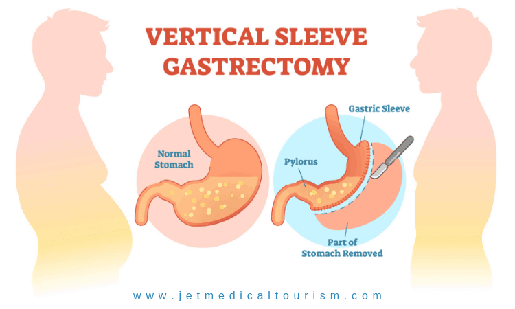 How Much Does Gastric Sleeve Cost? Weight Loss Surgery Cost