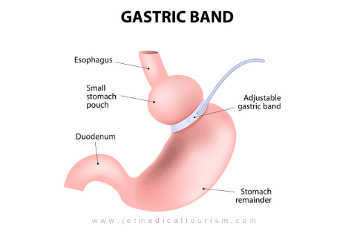 Lap Band Reversal Surgery in Mexico