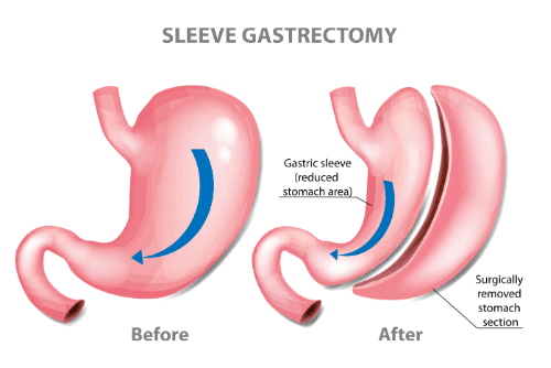 Gastric Sleeve Reversal in Mexico
