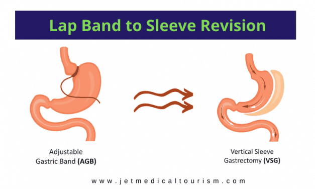 How to get lap band surgery approved