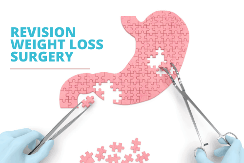 What is revision weight loss surgery