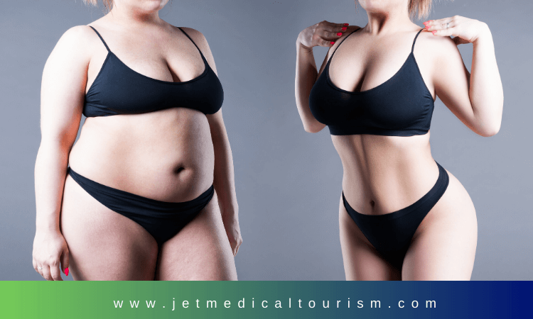 Gastric Sleeve in Mexico