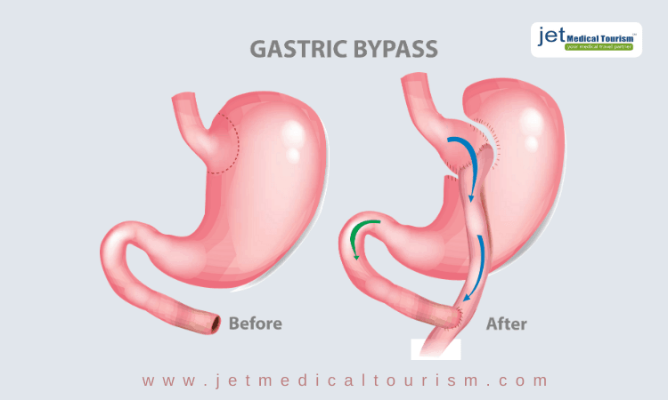Gastric Bypass Surgery in Mexico