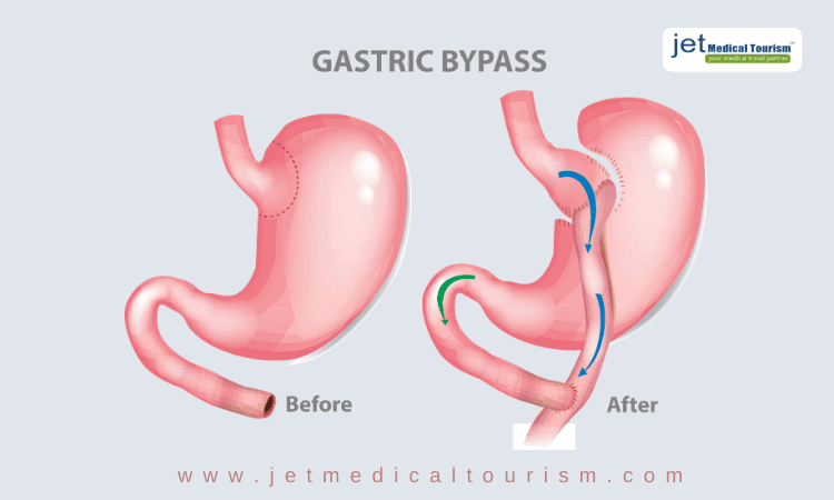 Gastric bypass mexico