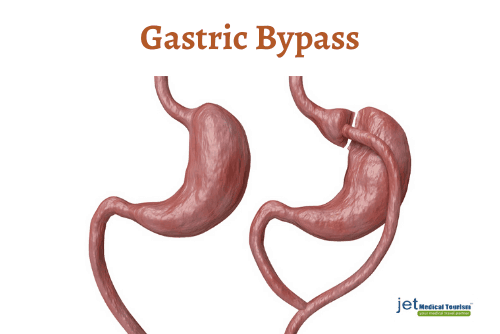 Gastric Bypass Surgery