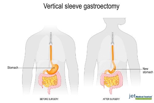 Morbid obesity BMI chart: Am I morbidly obese? Jet Medical Tourism®