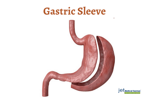 Gastric Sleeve in Mexico