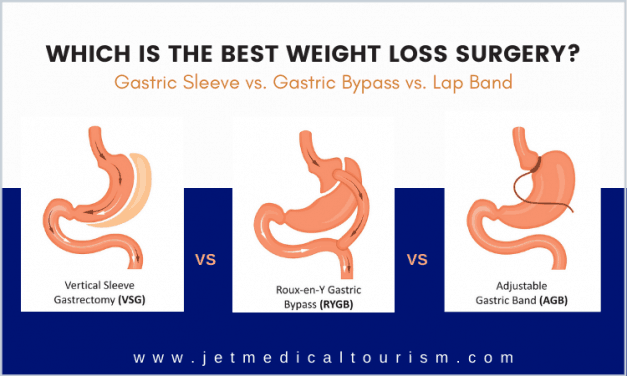 Gastric Sleeve vs. Gastric Bypass vs. Lap Band: Which is The Best Weight Loss Surgery?