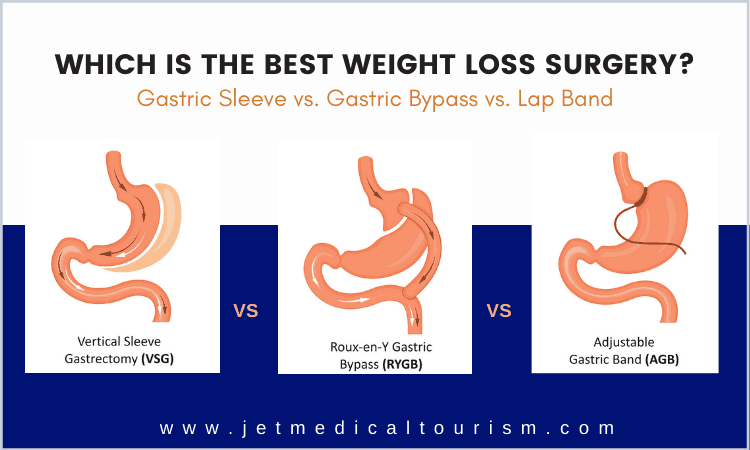 Gastric Sleeve vs Gastric Bypass vs Lap Band