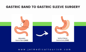 Lap Band to Gastric Sleeve Conversion in Mexico | Jet Medical Tourism®