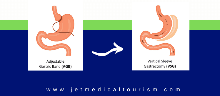 Gastric Lap Band Revision Surgery in Mexico Lap Band Removal