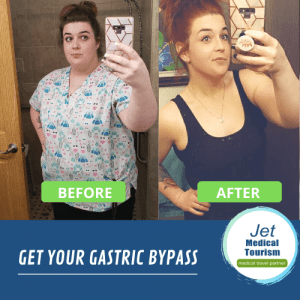 Carole's Before and After Gastric Bypass Picture