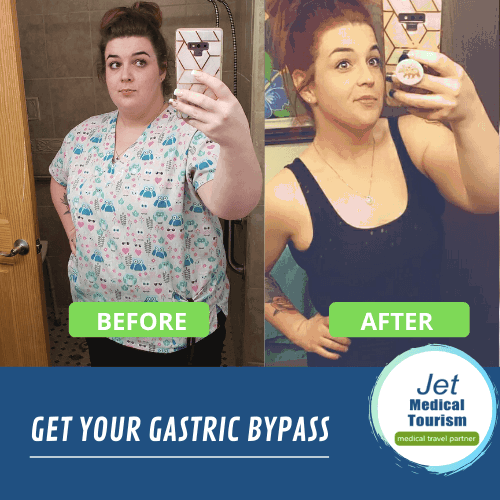 gastric bypass surgery before and after pic