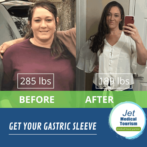 Candy's Gastric sleeve before and after photo