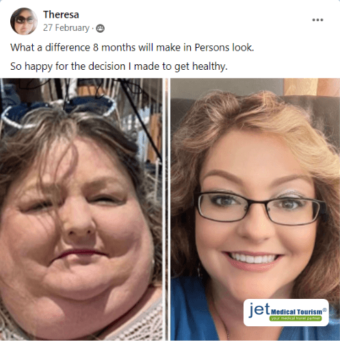 Gastric sleeve patient success story