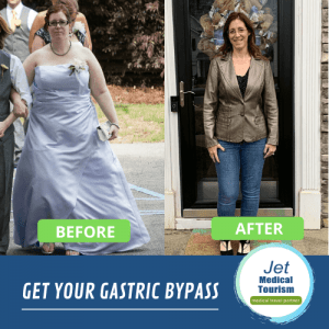 Jodi's Before and After Gastric Bypass Picture