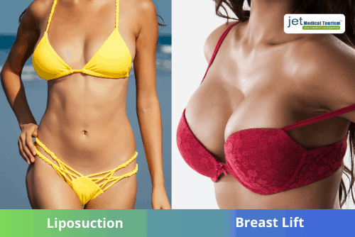 Liposuction and Breast Lift