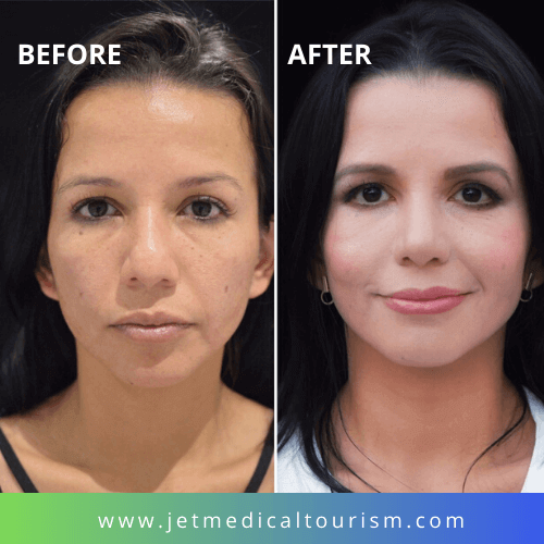 mexico nose job before and after pictures 12
