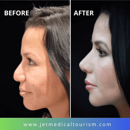 nose job cost in new mexico