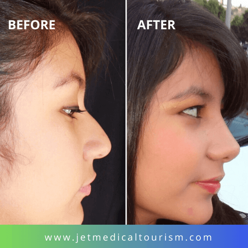 mexico nose job before and after pictures 9