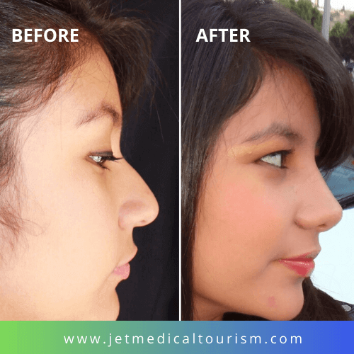 how much is a nose job in mexico city