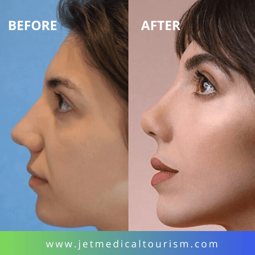 nose plastic surgery cost in mexico