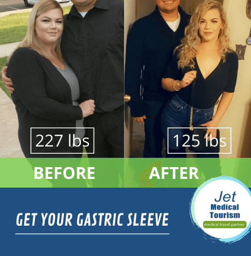 Gastric Sleeve Before and After Stories