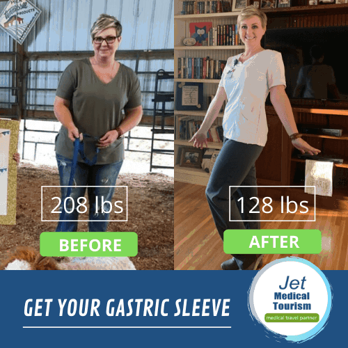 Gastric Sleeve Before and After Photos