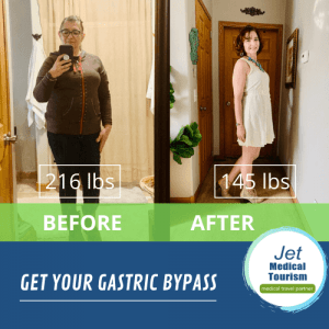 Zulema's Before and After Gastric Bypass Picture