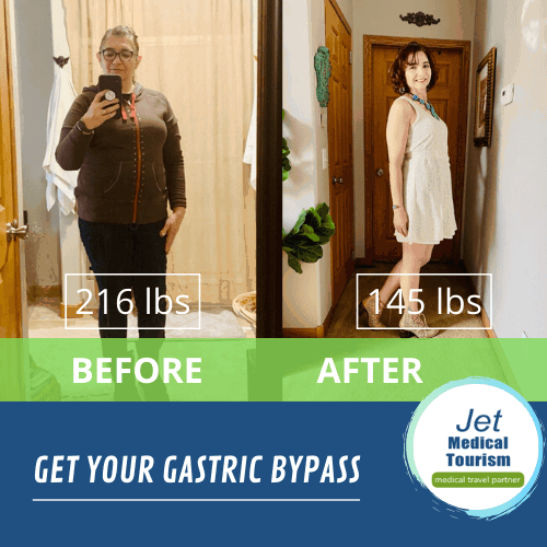 Gastric Bypass Before and After Picture of Zulema