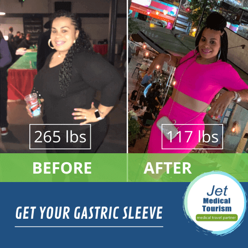 Gastric Sleeve Mexico Before and After