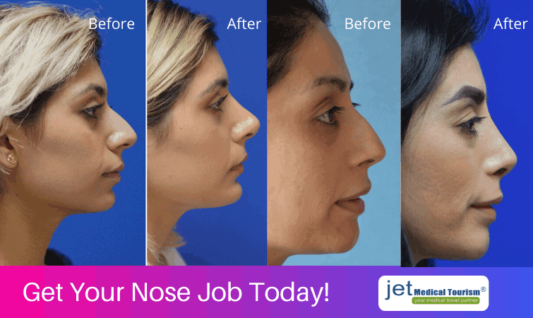 Nose Job Before and After.
