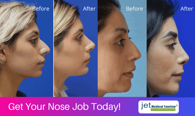 nose job in Mexico. 