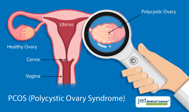 What is PCOS