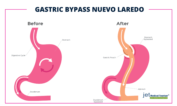 Gastric Bypass Nuevo Laredo