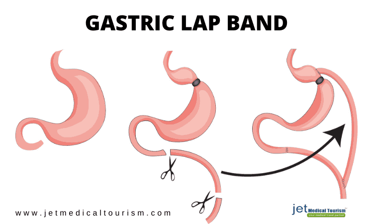 Gastric Band Removal