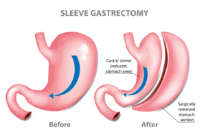 Gastric Sleeve Weight Loss Chart and Timeline 2021