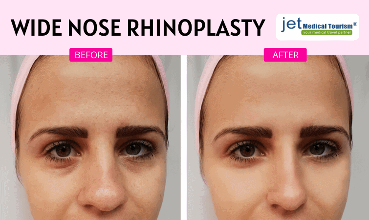 Wide nose rhinoplasty before and after